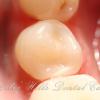 After removing the patient's old tooth-colored filling and the decay underneath, a new, more durable material was placed. The patient was very happy with the highly esthetic result.